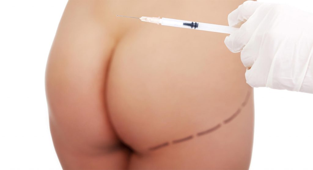 Imagem de glúteo feminino com uma seringa para ilustrar conteúdo de aumento de glúteos com gordura.