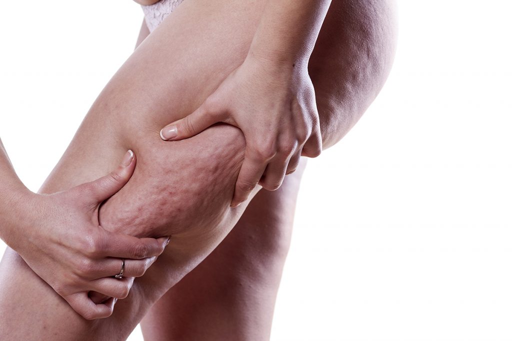 Mulher pressionando pernas para ver celulite. Imagem utilizada para ilustrar conteúdo sobre endolaser, um tratamento contra celulite.